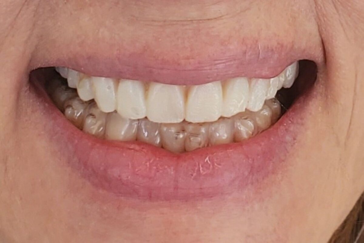 chinook-smiles-calgary-dr-chloe-xu-cosmetic-case -after1