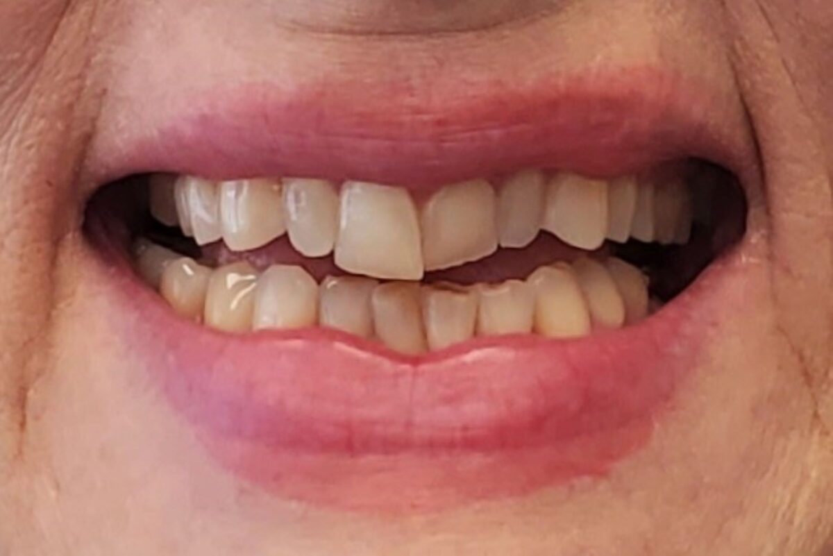 chinook-smiles-calgary-dr-chloe-xu-cosmetic-case-before1