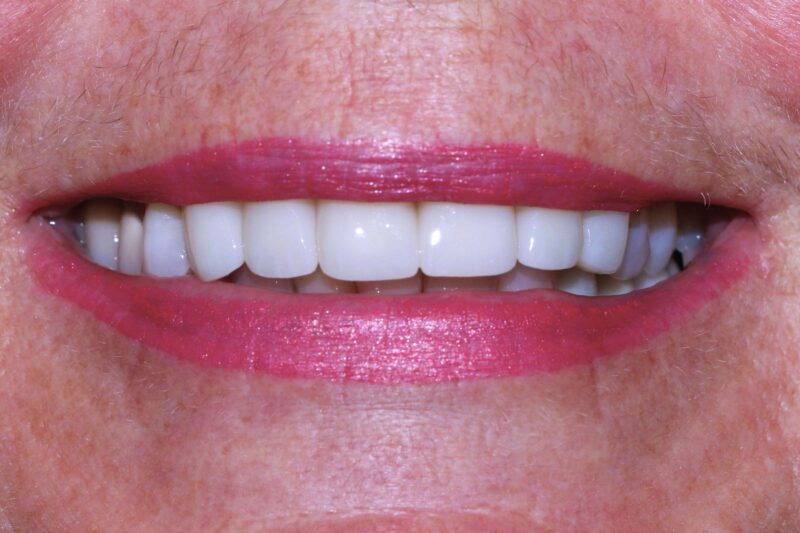 chinook-smiles-calgary-dr-chloe-xu-cosmetic-smiles-makeover-after