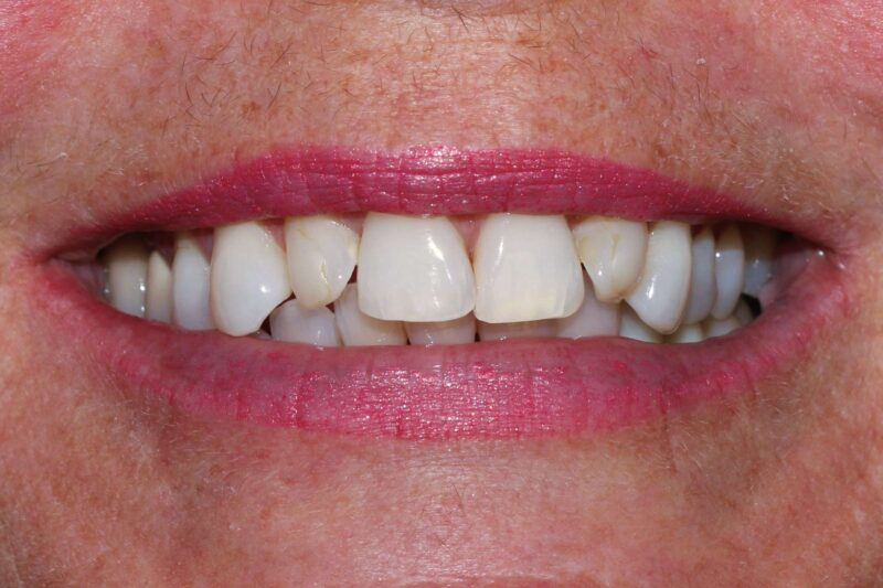 chinook-smiles-calgary-dr-chloe-xu-cosmetic-smiles-makeover-before