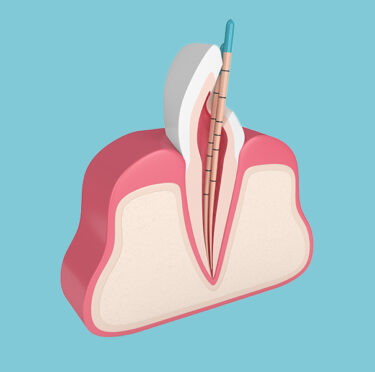Is a Root Canal as Painful as People Say? Let’s Find Out