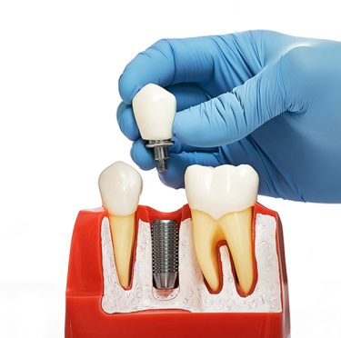 Dental Implants vs. Bridges: Which One Is Right for You?