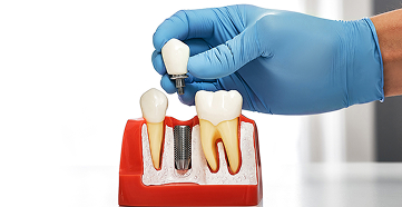 Offering Free Consultation for Implants