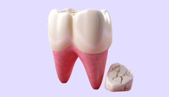Cracked Tooth Solutions: Is Pulling the Tooth the Only Option?