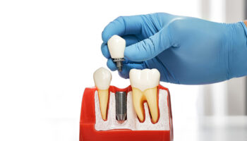 Dental Implants vs. Bridges: Which One Is Right for You?
