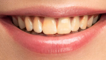 Is Vitamin D Deficiency Turning Your Teeth Yellow?