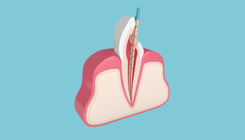 Is a Root Canal as Painful as People Say? Let’s Find Out