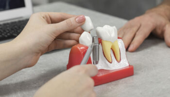 The Impact of Dental Implants on Jawbone Health